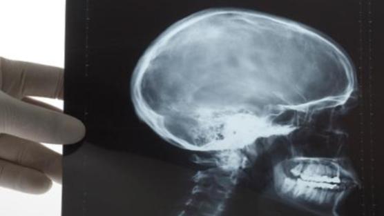 hand holding a xray of a human head