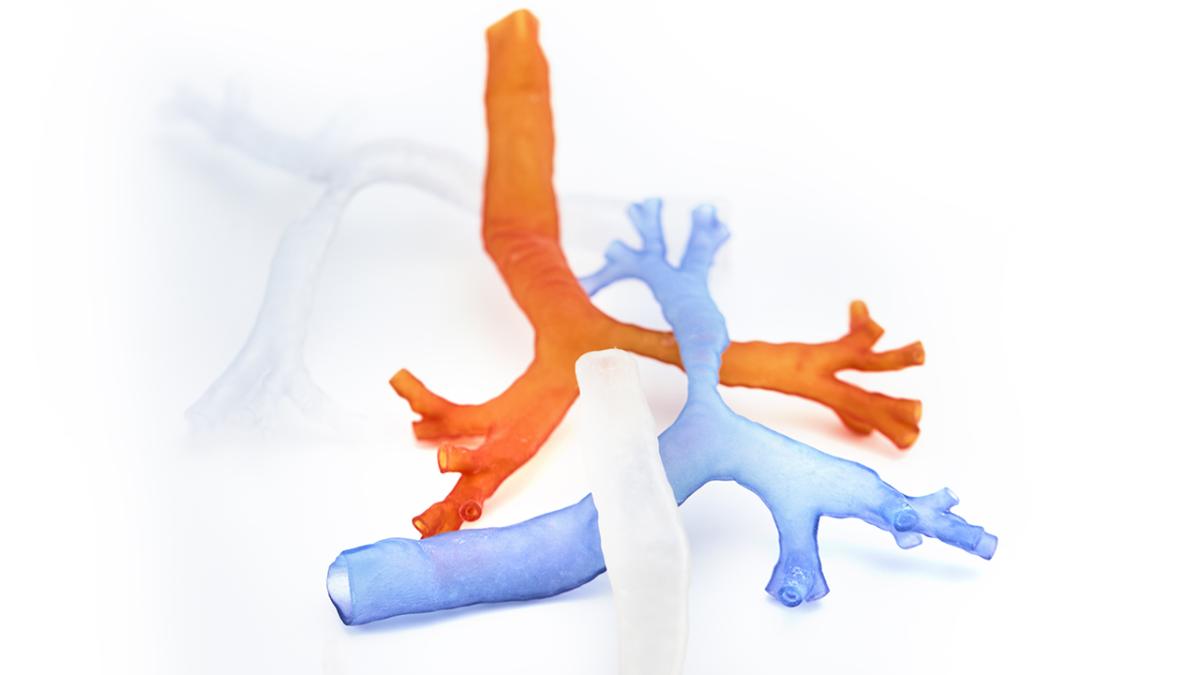 3D printed tracheas used to plan surgery created by Tyree IHealthE.
